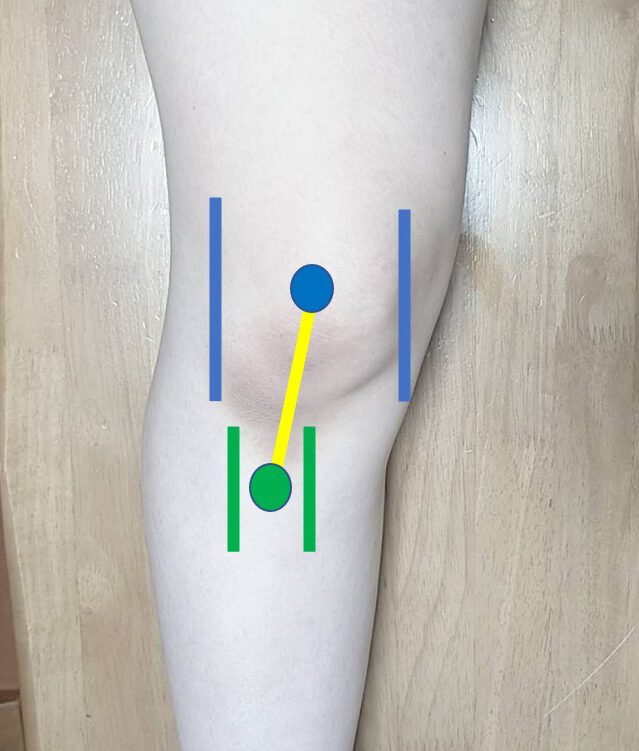 膝の痛みと捻れ TASK熊本